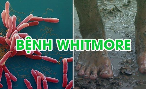 Bệnh Whitmore là bệnh gì- Bệnh có thật sự nguy hiểm?